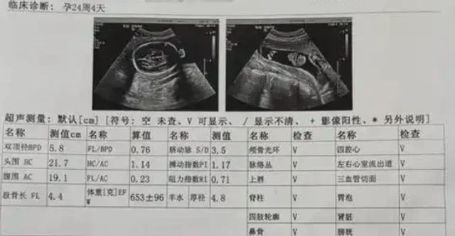 产检记录里的 B 超单